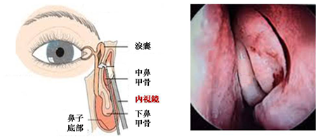 淚道阻塞,眼淚過多,淚道探通術(shù),淚囊鼻腔吻合手 淚道阻塞,眼淚過多,淚道探通術(shù),淚囊鼻腔吻合手