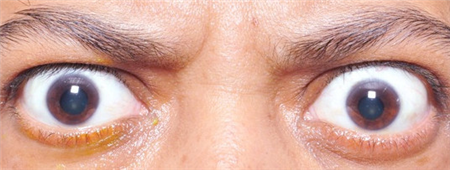 甲狀腺眼病,甲狀腺眼病治療,甲狀腺突眼怎么辦 甲狀腺眼病,甲狀腺眼病治療,甲狀腺突眼怎么辦