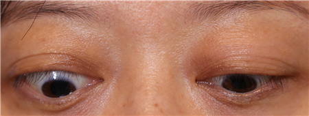 甲狀腺眼病,甲狀腺眼病治療,甲狀腺突眼怎么辦 甲狀腺眼病,甲狀腺眼病治療,甲狀腺突眼怎么辦