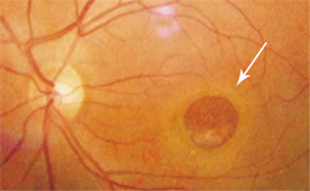黃斑裂孔,黃斑裂孔癥狀,黃斑裂孔治療,玻璃體切 黃斑裂孔,黃斑裂孔癥狀,黃斑裂孔治療,玻璃體切
