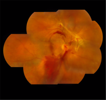 糖尿病對眼睛有什么影響