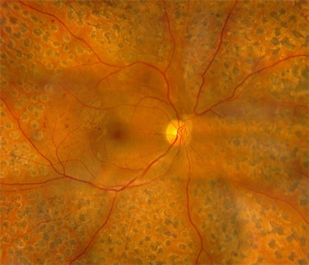 糖網病激光治療