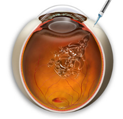 北京治療糖網病哪家醫院好
