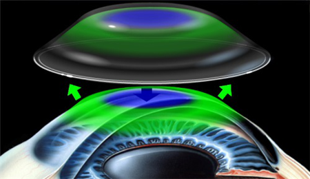 近視,兒童近視,小兒近視,ok鏡,角膜塑形鏡,角膜塑 近視,兒童近視,小兒近視,ok鏡,角膜塑形鏡,角膜塑