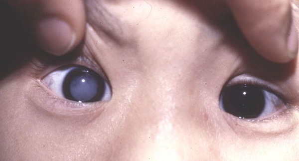 先天性,白內障,兒童 先天性,白內障,兒童