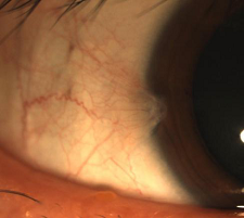 眼睛里也能長“魚肉”?你沒看錯，翼狀胬肉了解一下?