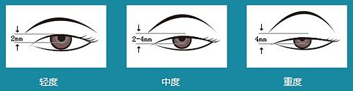 上瞼下垂,眼睛睜不開,腫眼泡 上瞼下垂,眼睛睜不開,腫眼泡