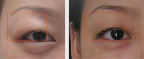 上瞼下垂,眼睛睜不開,腫眼泡 上瞼下垂,眼睛睜不開,腫眼泡