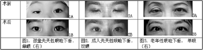 上瞼下垂,眼睛睜不開,腫眼泡 上瞼下垂,眼睛睜不開,腫眼泡