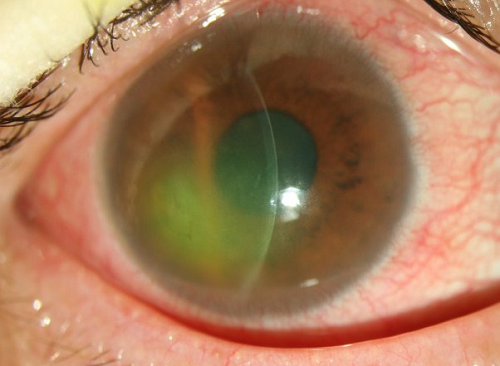 胬肉,角膜損傷,眼角膜,眼表 胬肉,角膜損傷,眼角膜,眼表