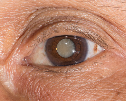 胬肉,角膜損傷,眼角膜,眼表 胬肉,角膜損傷,眼角膜,眼表