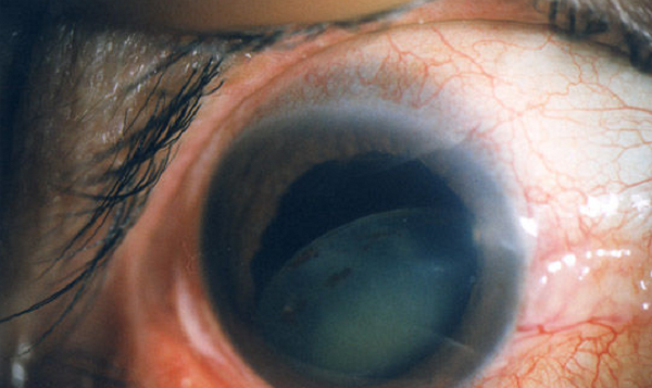 白內(nèi)障,青光眼,晶體變厚 白內(nèi)障,青光眼,晶體變厚