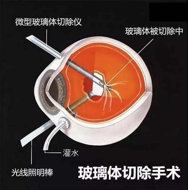 高度近視為什么會引起視網膜脫落呢？