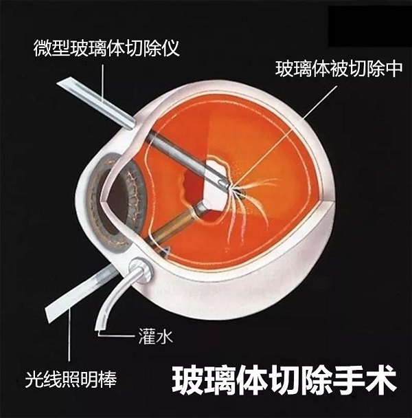 你真的了解視網膜嗎？如果視網膜脫落可以這樣治療！