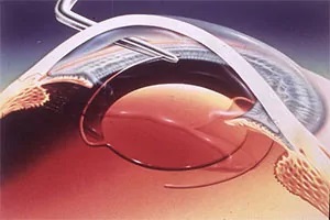 白內障的常規檢查都有哪些？