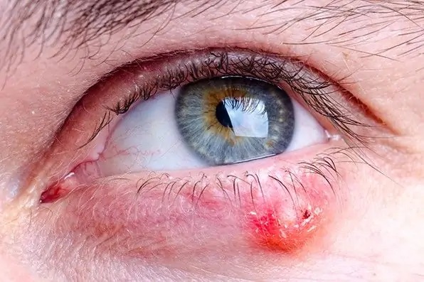 兒童引發麥粒腫的原因有哪些？